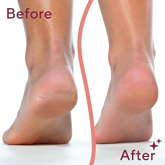Electric Pedicure Foot Care Tool – Rechargeable Callus Remover | Smooth Feet at Home